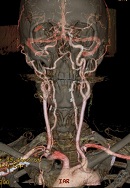 3D Carotid Angiogram