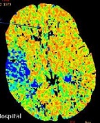 CT Brain perfusion scan